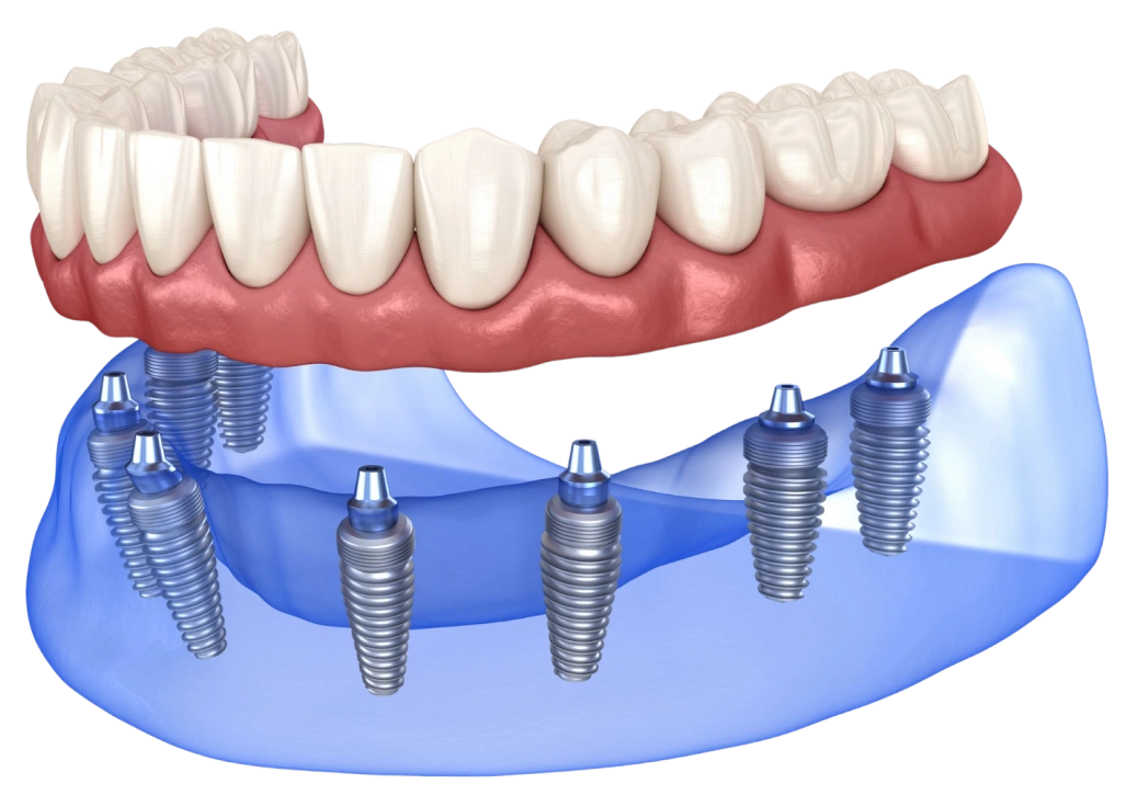 Dental implant prosthetic showing multiple titanium implants with tooth restoration bridge in blue model.